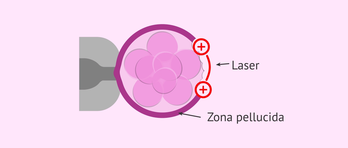 Laser_Assisted_Hatching.jpg